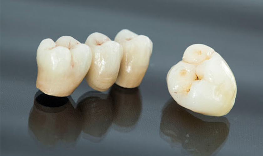 Giá bọc răng sứ bao nhiêu? Ở đâu bọc răng sứ?	