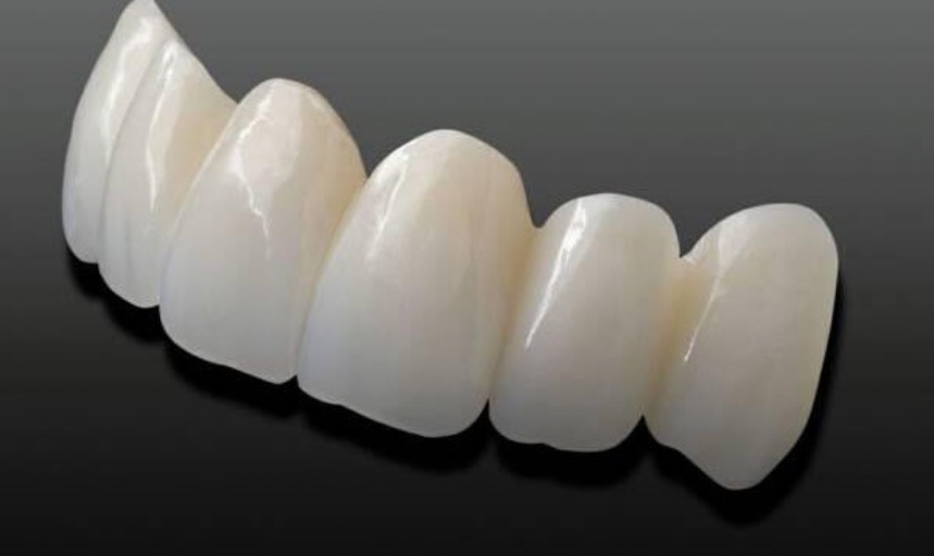 Bọc răng toàn sứ có các bước kỹ thuật khác nhau