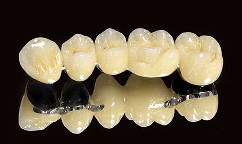 Trồng răng giả răng sứ giá bao nhiêu tiền? Ở đâu trồng răng sứ thẩm mỹ, giá rẻ?	