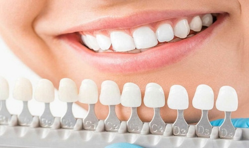 Các bước làm răng sứ Emax được tiến hành kỹ lưỡng